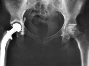 hipxray300x200.jpg hipxray300x200.jpg