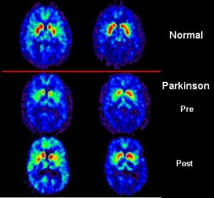 PET_scan_Parkinson's_Disease.jpg PET_scan_Parkinson's_Disease.jpg