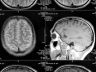 brain MRI