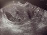 ultrasound