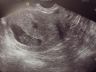 ultrasound